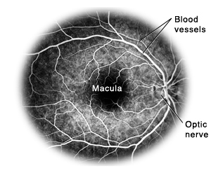 Flourescein angiogram of retina showing blood vessels, macula, and optic nerve.
