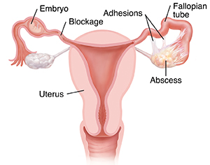 Front view of uterus with complications of pelvic inflammatory disease such as ectopic pregnancy, adhesions, blockage, and abscess.