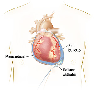 Front view of person's chest showing the heart and a cross section of the pericardium. A balloon catheter is being inflated in the pericardium.