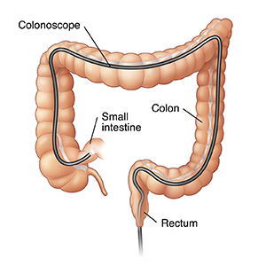 Front view of colon showing scope inserted through anus into entire colon.