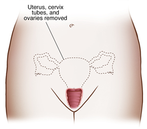 Front view of female pelvis showing reproductive organs and dotted line outlining uterus, cervix , fallopian tubes, and ovaries to show hysterectomy with salpingo-oophorectomy.