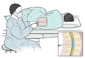 Healthcare provider inserting needle into lower spine of draped patient lying on her side. Inset shows cross section of lumbar spine with needle inserted into spinal canal.