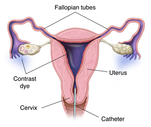 Front view cross section of uterus showing catheter inserted through cervix releasing dye into uterus and fallopian tubes.