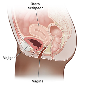 Vista lateral de corte transversal de la pelvis femenina donde se observa un prolapso de la cúpula vaginal.
